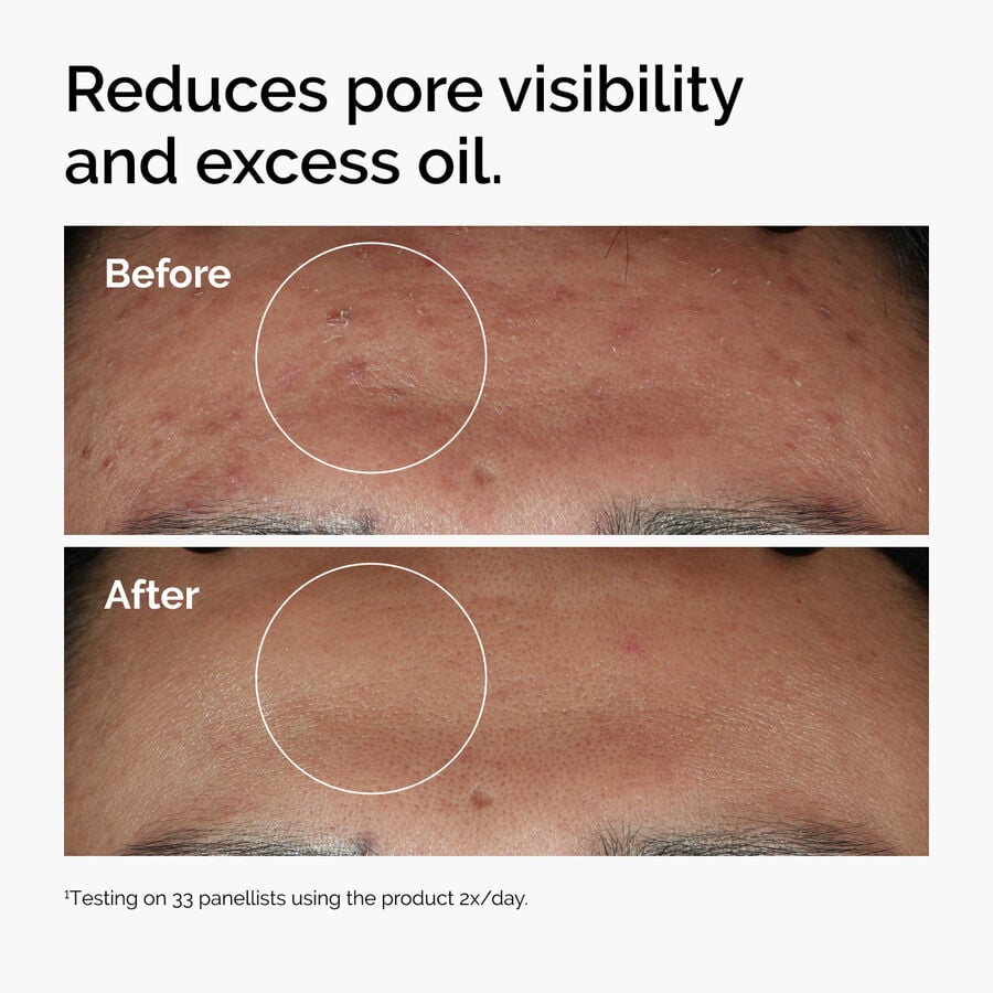 niacinamide-10-zinc-1-a8 ord-niacinamide-zinc-blemish-serum-before-after-pores.jpg