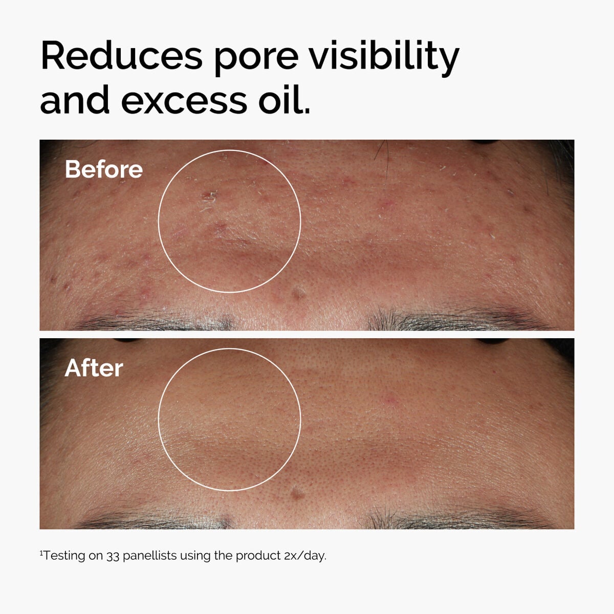 niacinamide-10-zinc-1-a8 ord-niacinamide-zinc-blemish-serum-before-after-pores.jpg